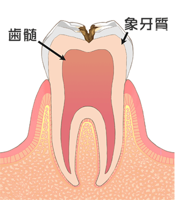 C2[象牙質のむし歯]